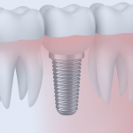 Implantes en una sola sesión